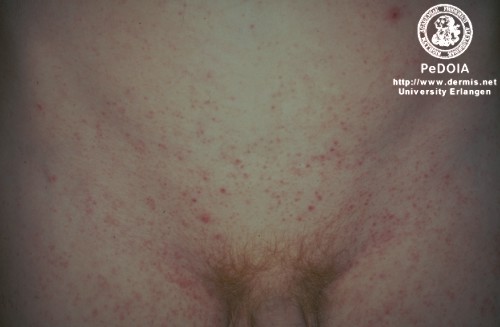 Children's rashes and spots in pictures - Made For Mums