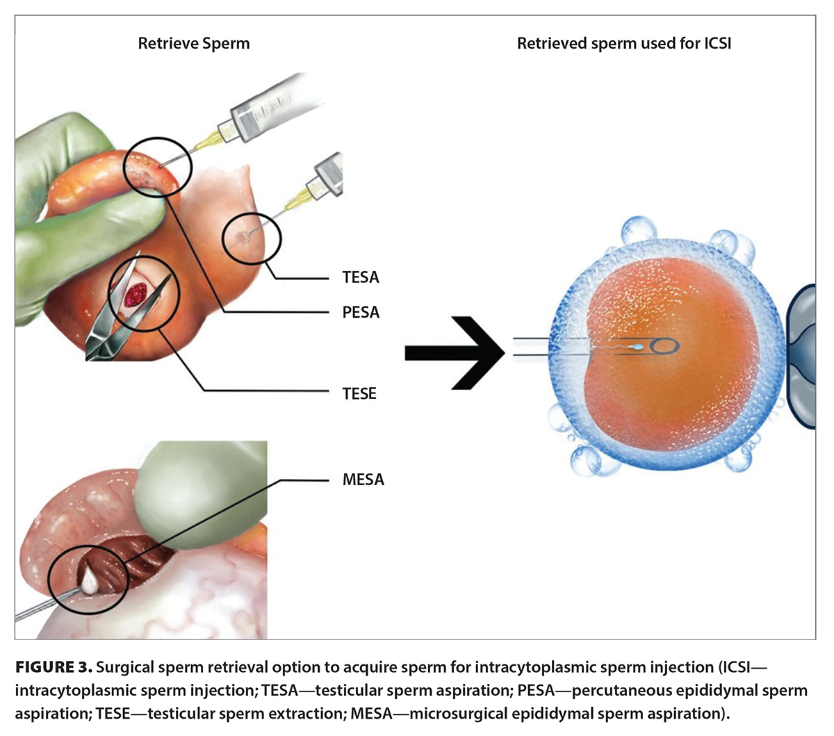 Fertility Treatment Options After Vasectomy British Columbia Medical 