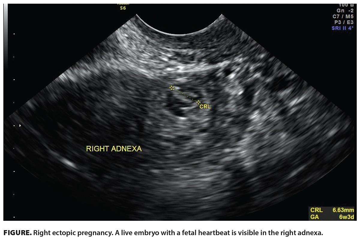 Diagnosing ectopic pregnancy in the emergency setting