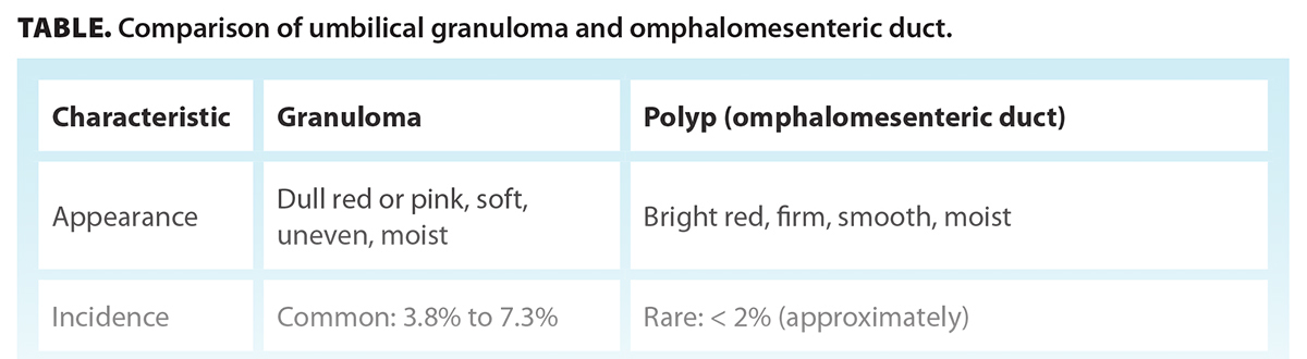 TABLE. Comparison of umbilical granuloma and omphalomesenteric duct.