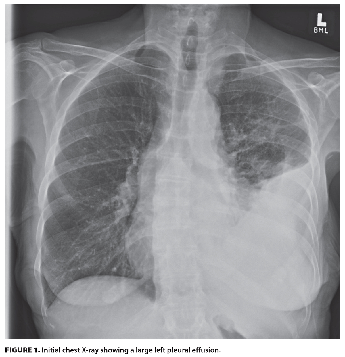FIGURE 1. Initial chest X-ray showing a large left pleural effusion.