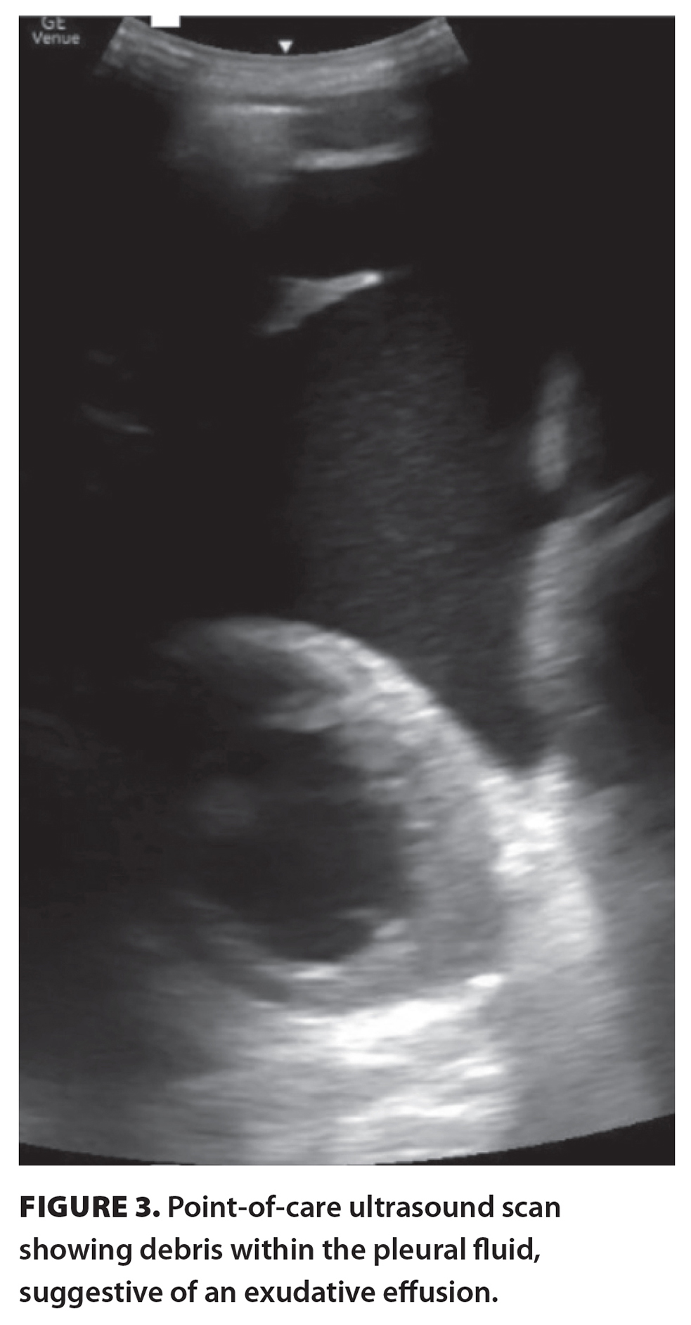 FIGURE 3. Point-of-care ultrasound scan showing debris within the pleural fluid, suggestive of an exudative effusion.