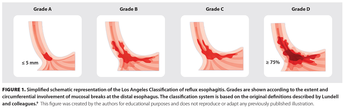 FIGURE 1. Simplified schematic representation of the Los Angeles Classification of reflux esophagitis. Grades are shown according to the extent and circumferential involvement of mucosal breaks at the distal esophagus.