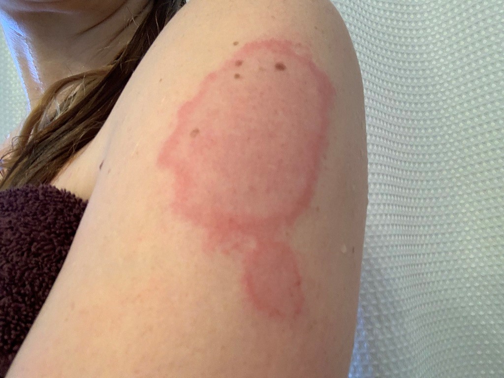 Covid Arm Skin Reactions At Injection Site Of Moderna Vaccine In Bc Case Reports British Columbia Medical Journal