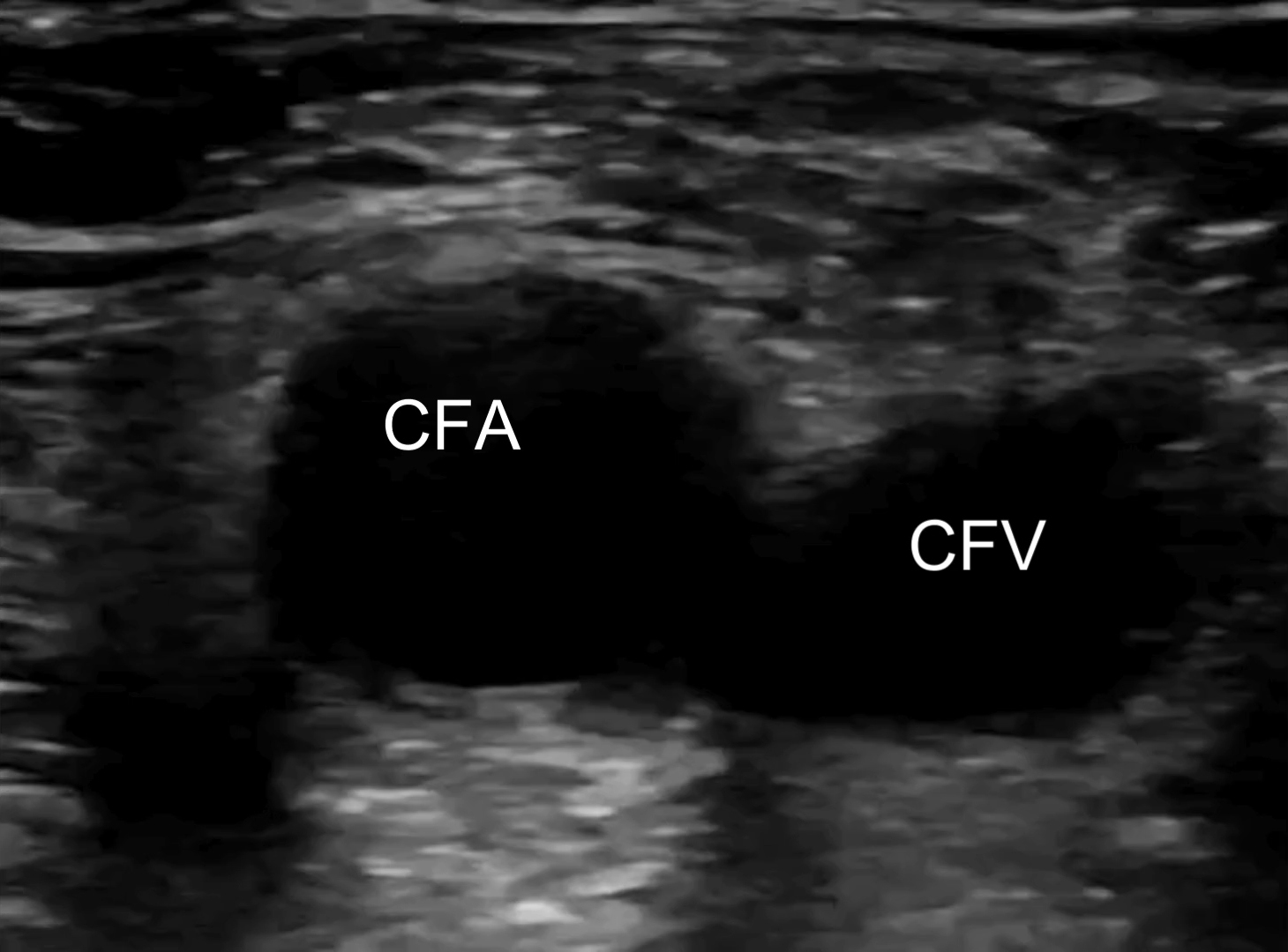 Point-of-care ultrasound images of right-leg deep veins and arteries viewed in transverse, without and with compression. Proximal common femoral vein (CFV) and proximal common femoral artery (CFA).