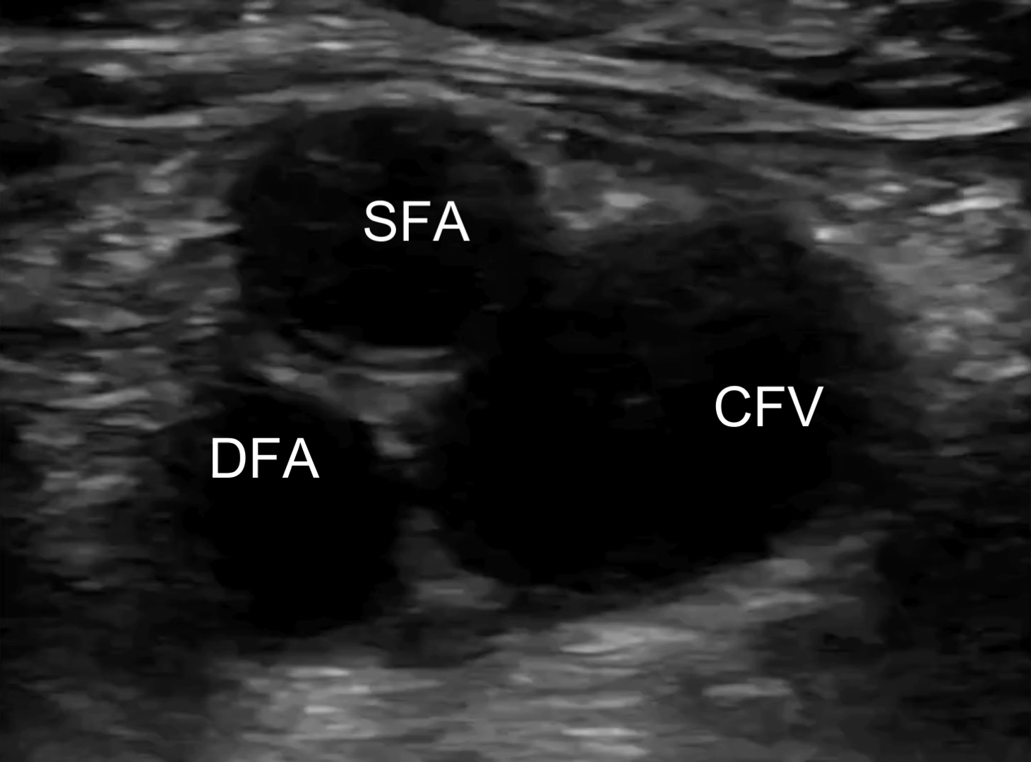 Point-of-care ultrasound images of right-leg deep veins and arteries viewed in transverse, without and with compression. Distal CFV, and bifurcation of the CFA into superficial femoral artery (SFA) and deep femoral artery (DFA).