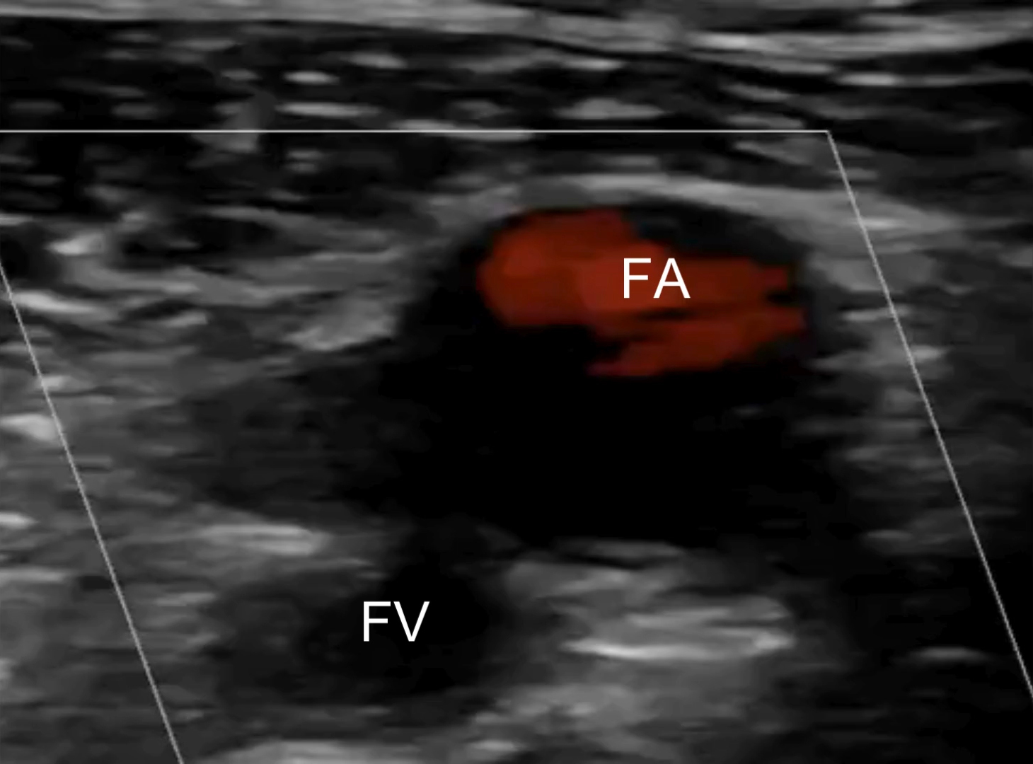 Point-of-care ultrasound images of right-leg deep veins and arteries viewed in transverse, without and with compression. Femoral vein (FV) and femoral artery (FA).