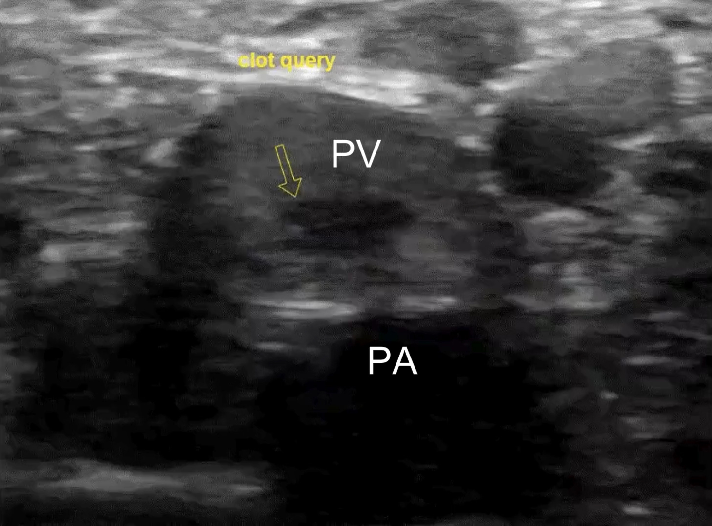 Point-of-care ultrasound images of right-leg deep veins and arteries viewed in transverse, without and with compression. Popliteal vein (PV) and popliteal artery (PA). The noncompressible distal CFV extends to the PV, with a possible thrombi in the PV.