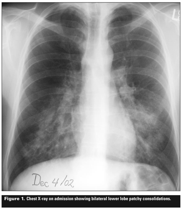 Severe Bilateral Pneumonia
