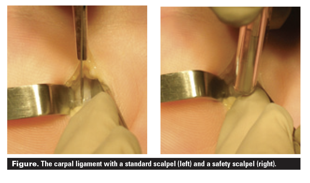 Figure 1. The carpal ligament with a standard scalpel (left) and a safety scalpel (right)