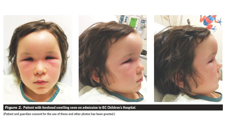 Forehead swelling in a 10-year-old male: A case report | British ...