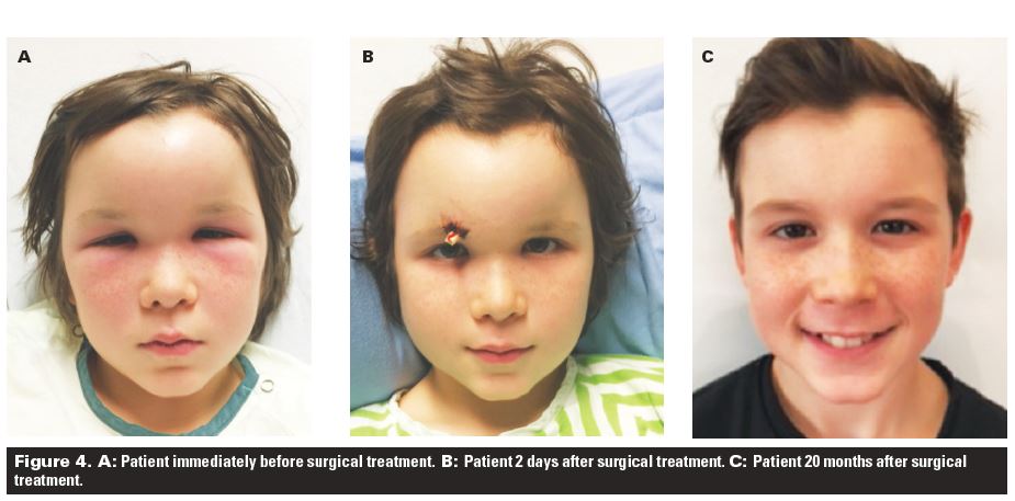 4 Times Sinusitis A Year