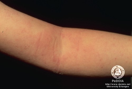 Pruritus in Children: What's Itching?