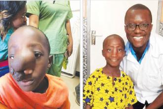 Samuel prior to the surgery and with Dr Alvin Nah Doe, a KBNF member and Liberia’s sole neurosurgeon, who participated in Samuel’s surgery and treatment.