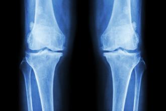 Osteoarthritis imaging: A survey of British Columbian doctors and evidence-based recommendations