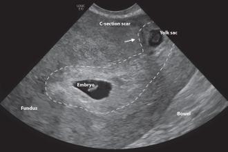Ultrasonographic findings and treatment in heterotopic cesarean scar pregnancy
