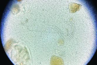 Strongyloides stercoralis larvae detected by stool microscopy.