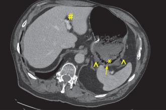 Initial CT scan on postadmission day 1 showing the presence of intramural gas, portal venous gas, hypoenhancing posterior stomach body, and gas in vasculature of stomach.