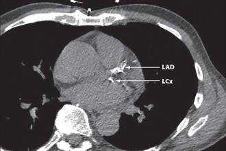 Sample coronary artery calcium scoring CT scan.