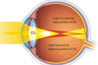 Beyond the cloudy lens: A physician’s guide to cataract treatment
