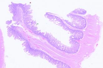 Cryptogenic multifocal ulcerous stenosing enteritis presenting as refractory iron deficiency anemia