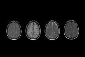 Serotonin syndrome presenting as posterior reversible encephalopathy syndrome in the setting of combined selective serotonin reuptake inhibitors and attention-deficit/hyperactivity disorder therapy