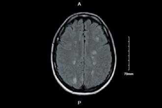 Serotonin syndrome presenting as posterior reversible encephalopathy syndrome in the setting of combined selective serotonin reuptake inhibitors and attention-deficit/hyperactivity disorder therapy
