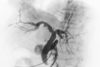 angiograph of the abdominal aorta 