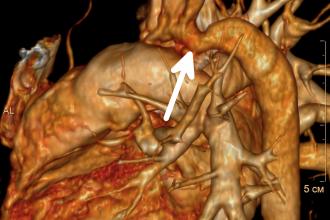 Aortic coarctation