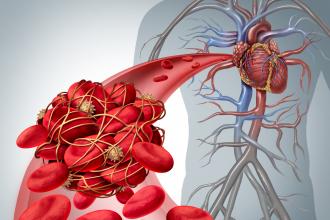 Blood Clot Risk