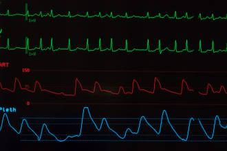 close up monitor showing atrial fibrillation