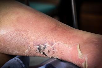 The feet of people with diabetes, dull and swollen. Due to the toxicity of diabetes, ulceration