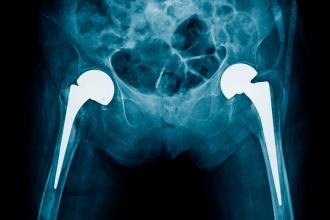 X-ray bilateral hip replacement, post operation total hip arthroplasty both side of old man