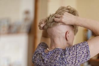 Alopecia areata: Navigating the emotional toll and financial burden of an unpredictable disease