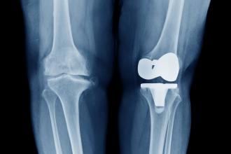 Osteoarthritis Knee ( OA Knee ) comparison on left arthroplasty / total knee replacement show metallic joint implant in bone and right knee Osteoarthritis show in front view