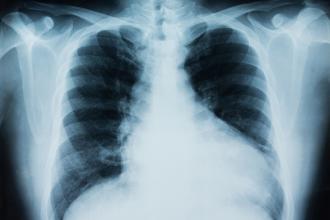 X ray of a lung with the right side filled with air