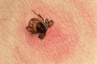 Tick bite