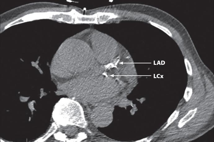 Early detection, lasting prevention: The significance of coronary artery calcium scores