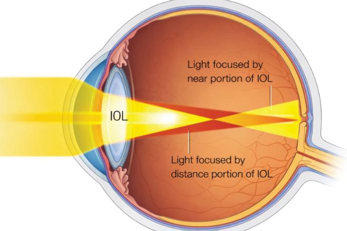 Beyond the cloudy lens: A physician’s guide to cataract treatment