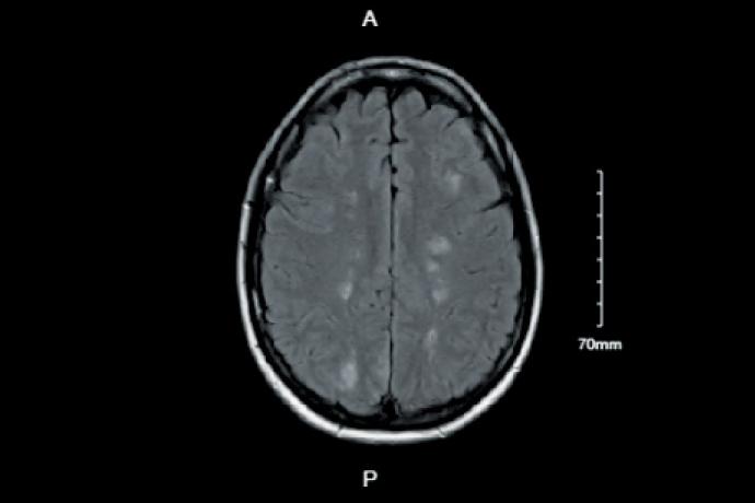 Serotonin syndrome presenting as posterior reversible encephalopathy syndrome in the setting of combined selective serotonin reuptake inhibitors and attention-deficit/hyperactivity disorder therapy
