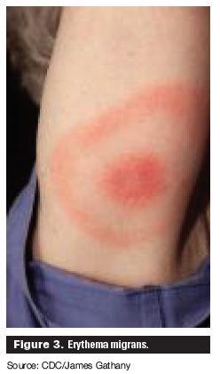 Figure 3. Erythema migrans