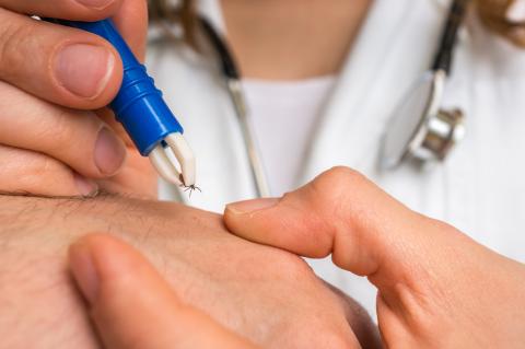 A doctor removes a tick from a patient using forceps.