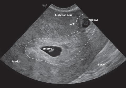 Sagittal transvaginal grayscale image of the uterus, showing two gestational sacs. An embryo is present in the gestational sac, normal implantation; a yolk sac is present in the ectopic cesarean scar gestational sac.