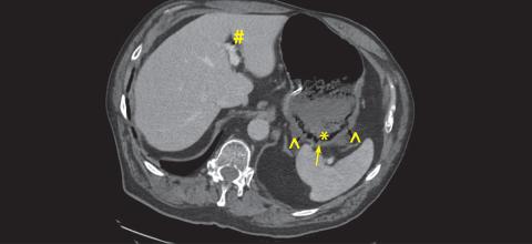 Initial CT scan on postadmission day 1 showing the presence of intramural gas, portal venous gas, hypoenhancing posterior stomach body, and gas in vasculature of stomach.