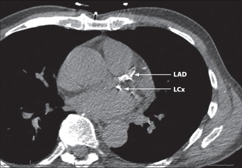 Sample coronary artery calcium scoring CT scan.