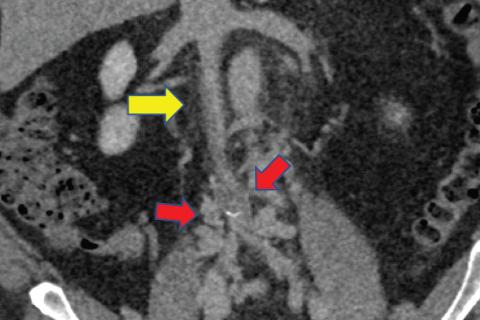 CT scan showing chronic occlusion of the inferior vena cava and bilateral common iliac veins.