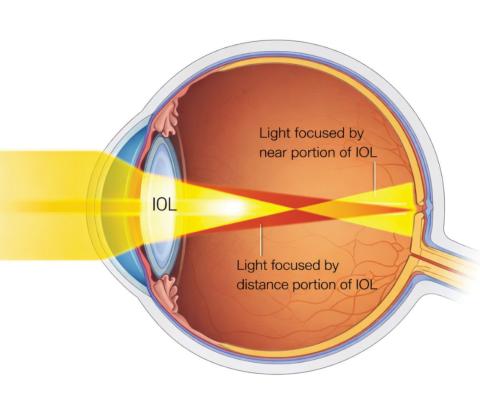 Simplified optics of a multifocal (bifocal) intraocular lens (IOL). Note that light is focused at multiple points, allowing clear vision at multiple distances.
