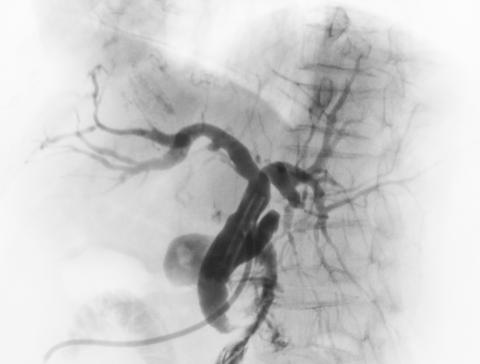 angiograph of the abdominal aorta 