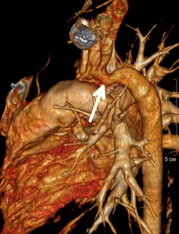 Aortic coarctation