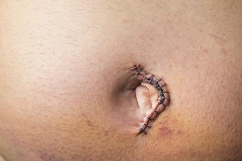Umbilical hernia repair surgery
